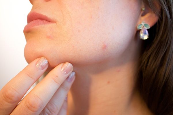 Czy wizyta u dermatologa online to skuteczne leczenie trądziku?